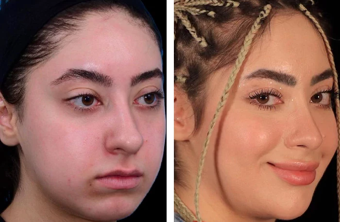 before & after photo of عمل زیبایی بینی