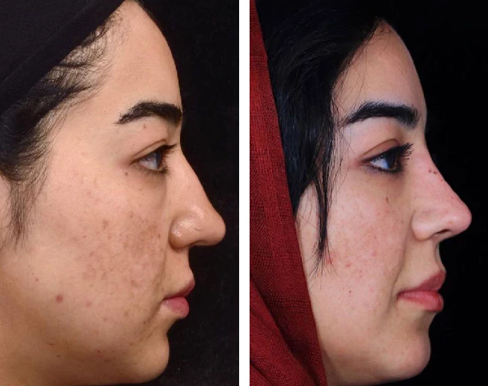 before & after photo of عمل زیبایی بینی