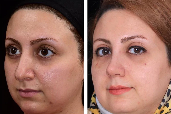 before & after photo of عمل زیبایی بینی