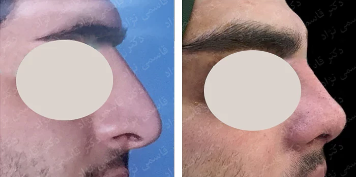 before & after photo of عمل زیبایی بینی