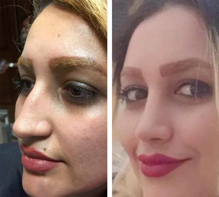 before & after photo of بلفاروپلاستی (جراحی پلک)