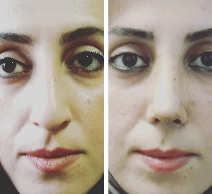 before & after photo of عمل زیبایی بینی