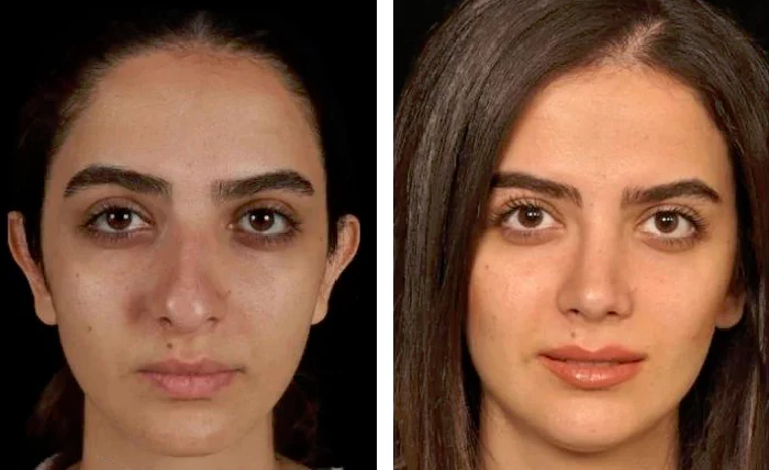 before & after photo of عمل زیبایی بینی