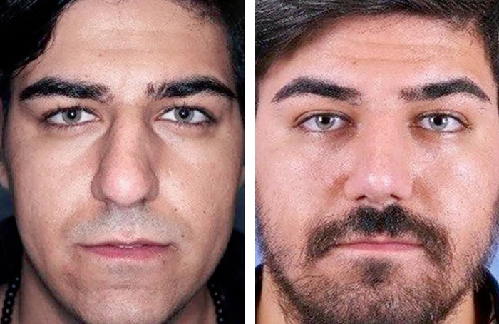 before & after photo of عمل زیبایی بینی