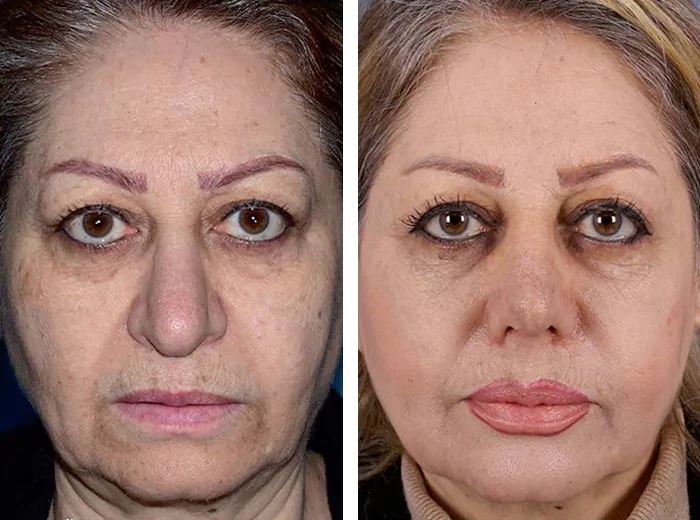 before & after photo of عمل زیبایی بینی