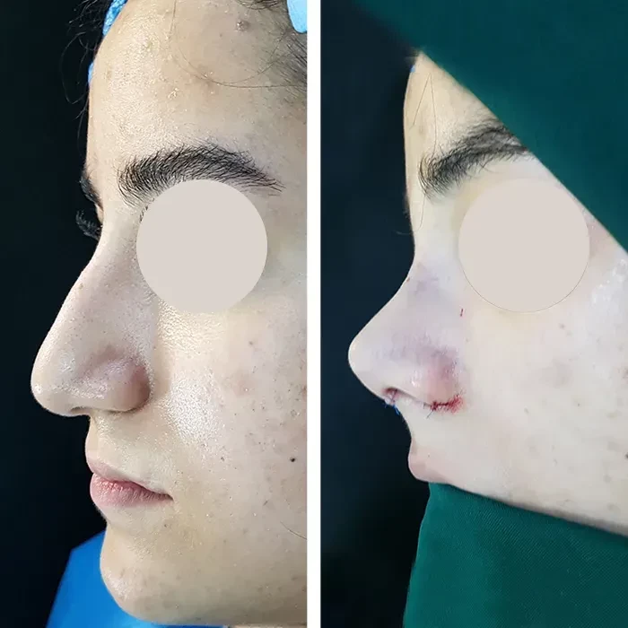 before & after photo of عمل زیبایی بینی