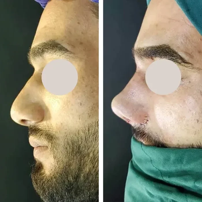 before & after photo of عمل زیبایی بینی