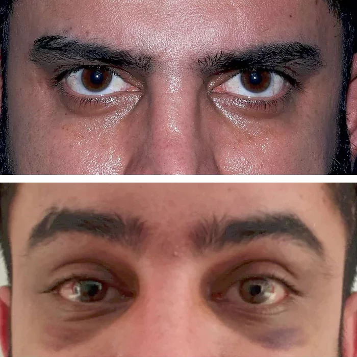 before & after photo of جراحی لیفت مستقیم ابرو