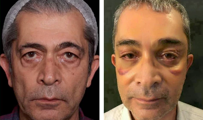 before & after photo of جراحی لیفت مستقیم ابرو