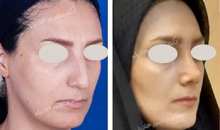 before & after photo of عمل زیبایی بینی