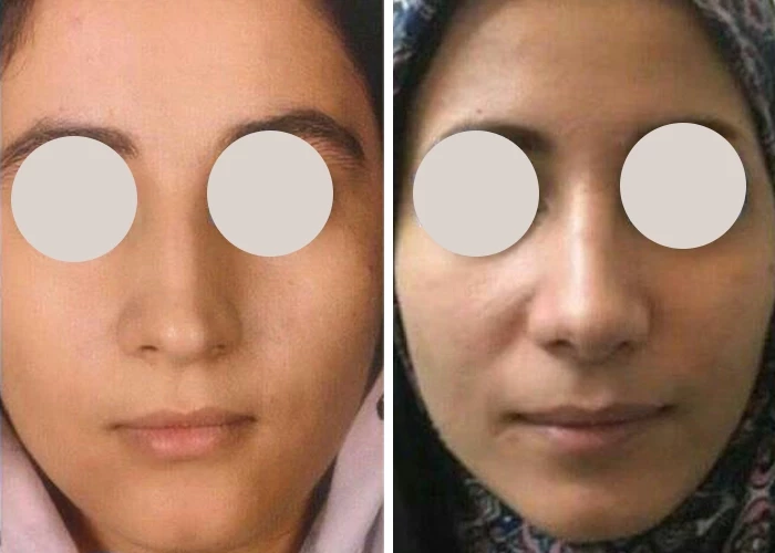 before & after photo of عمل زیبایی بینی