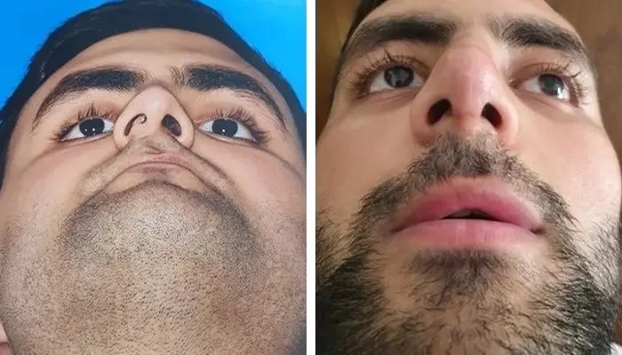 before & after photo of عمل زیبایی بینی