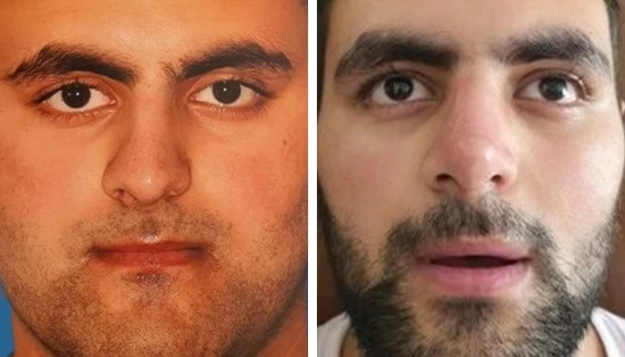 before & after photo of عمل زیبایی بینی