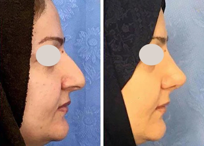 before & after photo of عمل زیبایی بینی