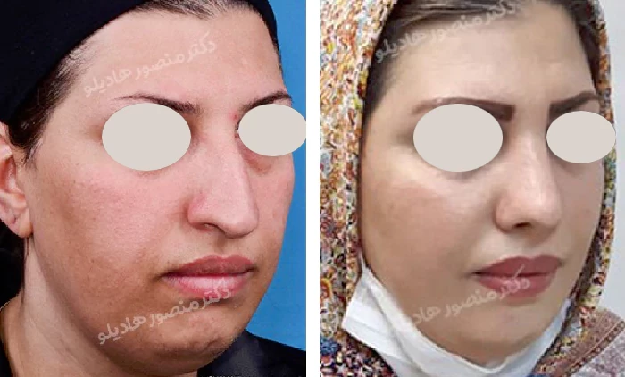 before & after photo of عمل زیبایی بینی