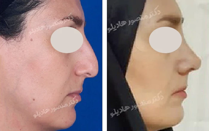 before & after photo of عمل زیبایی بینی