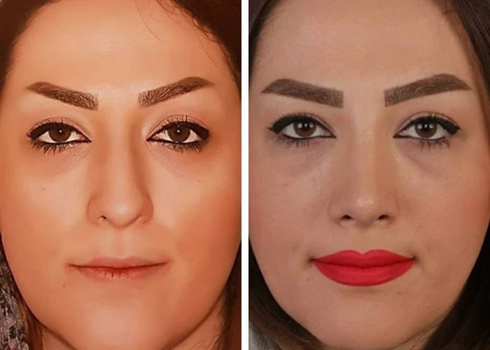 before & after photo of عمل زیبایی بینی