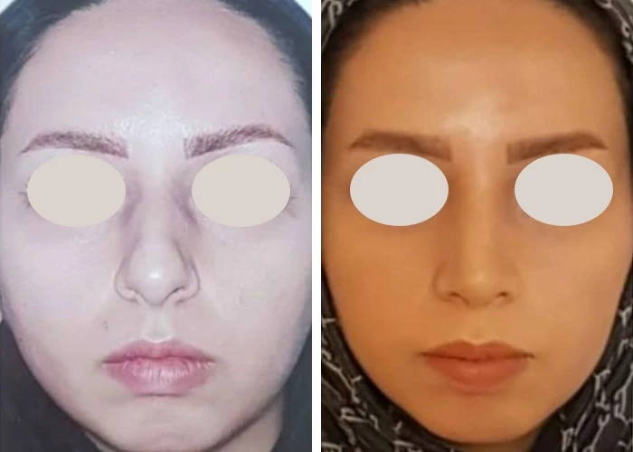 before & after photo of عمل زیبایی بینی