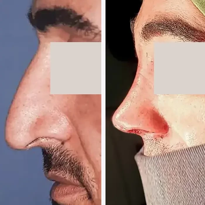 before & after photo of عمل زیبایی بینی