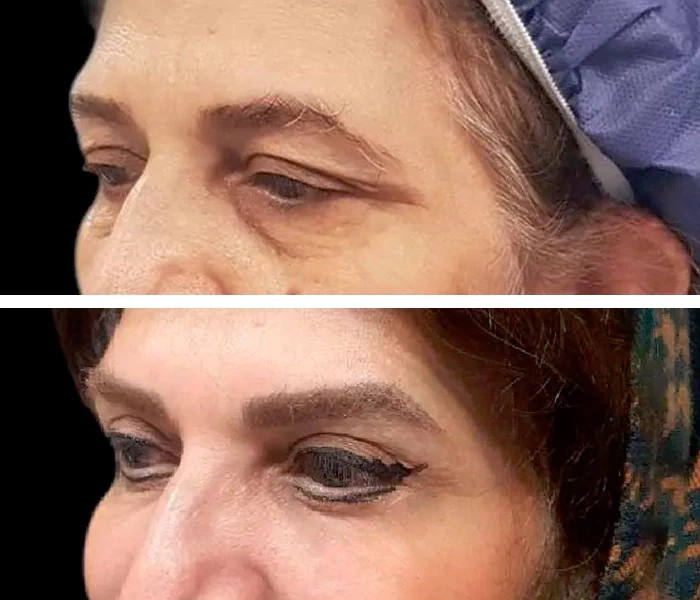 before & after photo of بلفاروپلاستی (جراحی پلک)