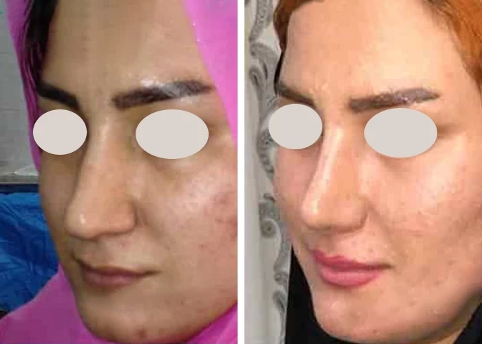 before & after photo of عمل زیبایی بینی