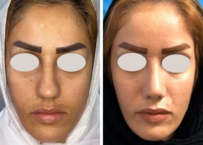 before & after photo of عمل زیبایی بینی