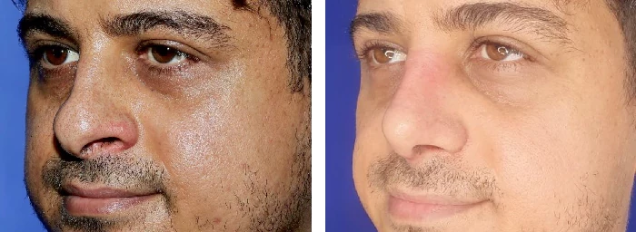 before & after photo of عمل زیبایی بینی