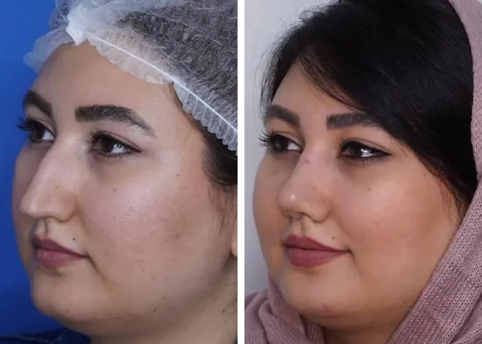 before & after photo of عمل زیبایی بینی