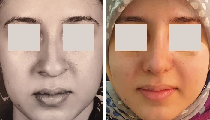 before & after photo of عمل زیبایی بینی