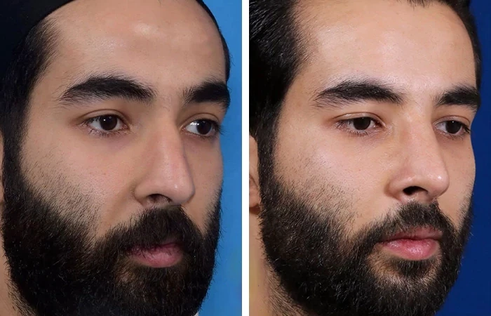 before & after photo of عمل زیبایی بینی