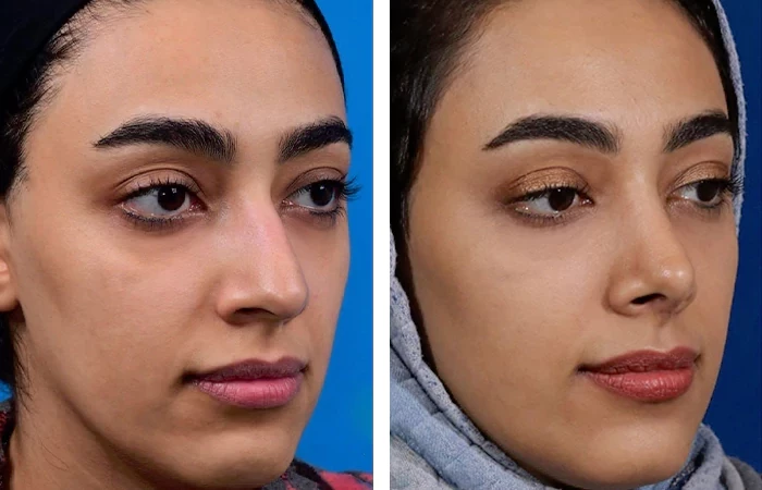 before & after photo of عمل زیبایی بینی