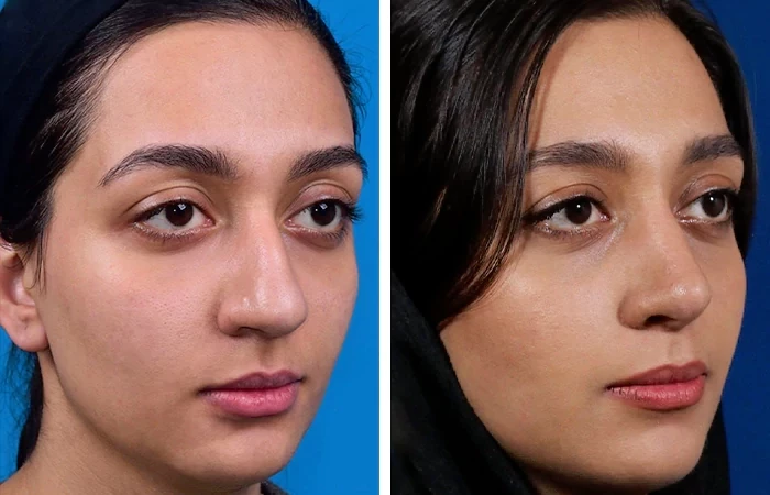 before & after photo of عمل زیبایی بینی