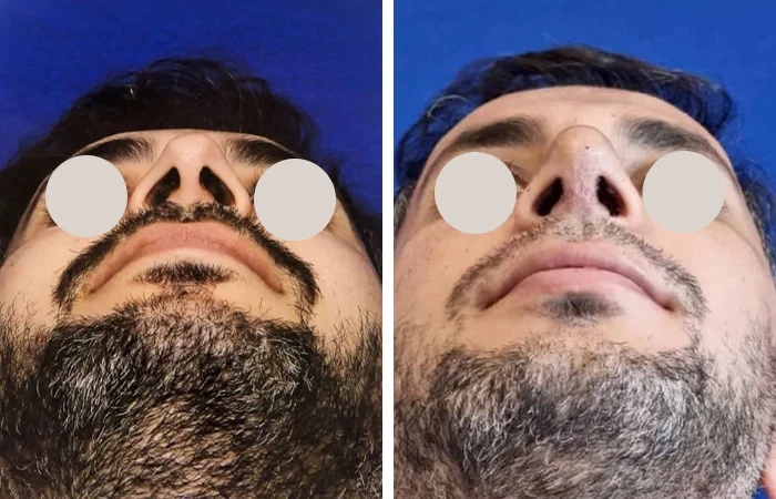 before & after photo of عمل زیبایی بینی