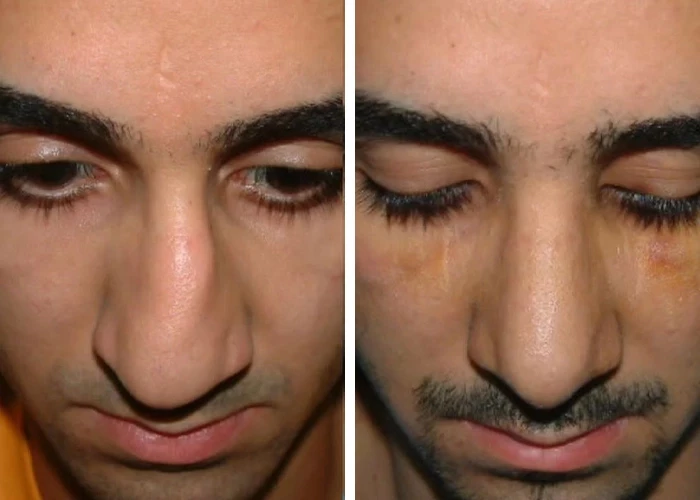 before & after photo of عمل زیبایی بینی