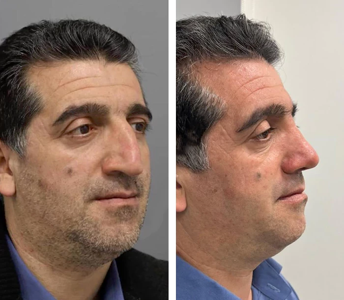 before & after photo of عمل زیبایی بینی