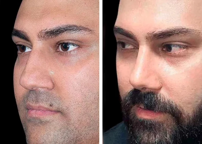 before & after photo of عمل زیبایی بینی