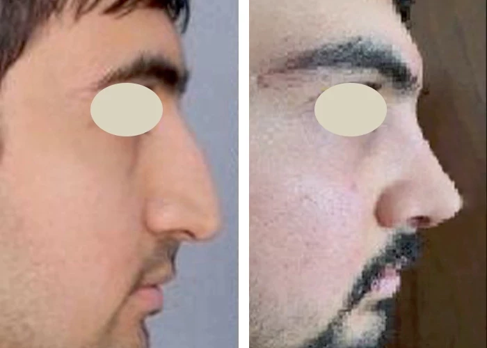 before & after photo of عمل زیبایی بینی