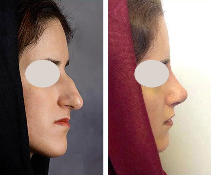 before & after photo of عمل زیبایی بینی