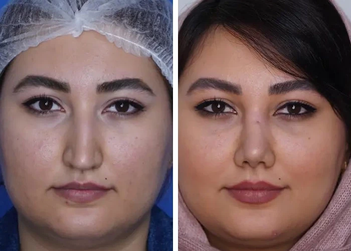 before & after photo of عمل زیبایی بینی