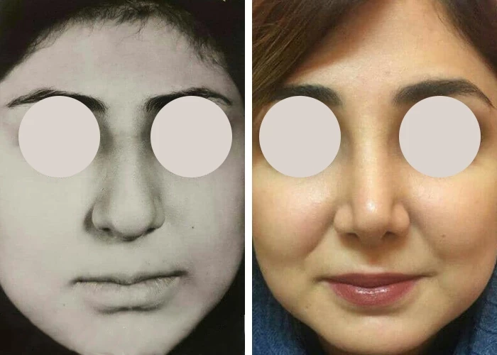 before & after photo of عمل زیبایی بینی