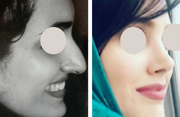 before & after photo of عمل زیبایی بینی