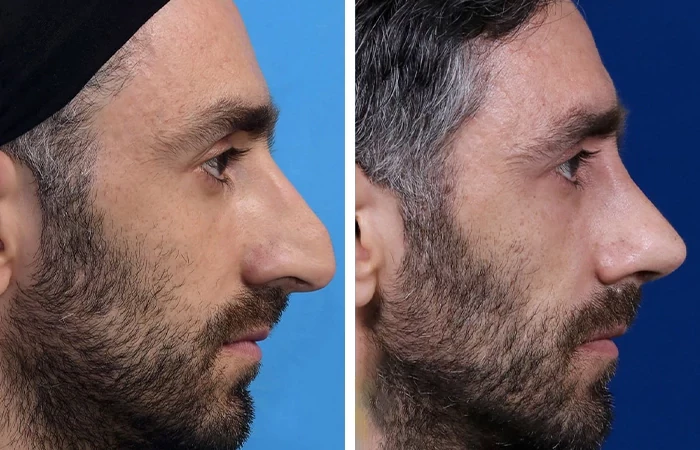 before & after photo of عمل زیبایی بینی