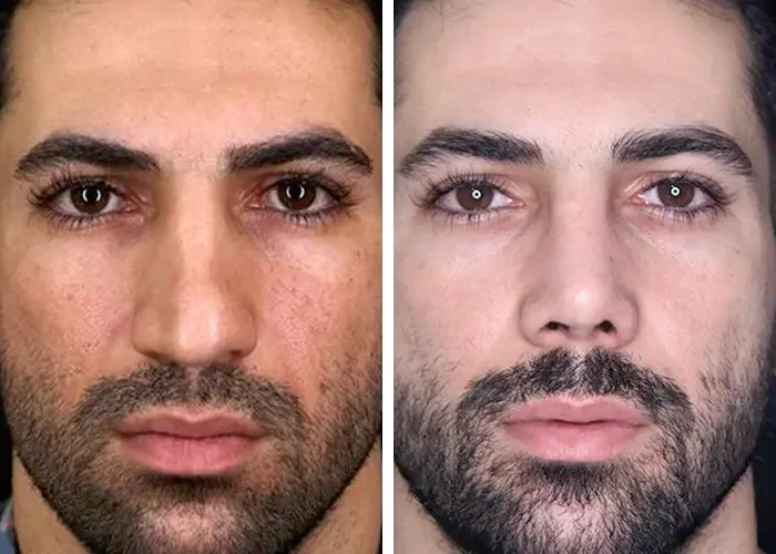 before & after photo of عمل زیبایی بینی