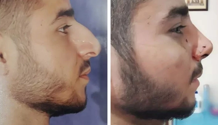 before & after photo of عمل زیبایی بینی