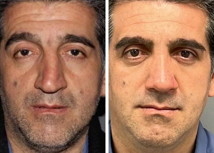 before & after photo of عمل زیبایی بینی