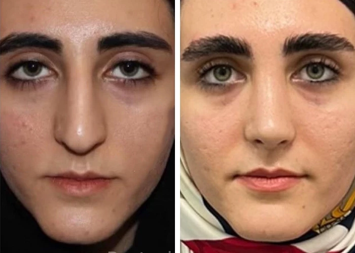 before & after photo of عمل زیبایی بینی