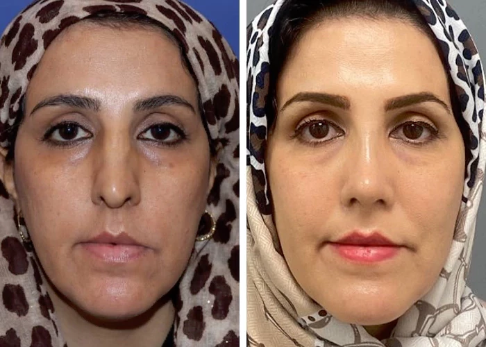 before & after photo of عمل زیبایی بینی