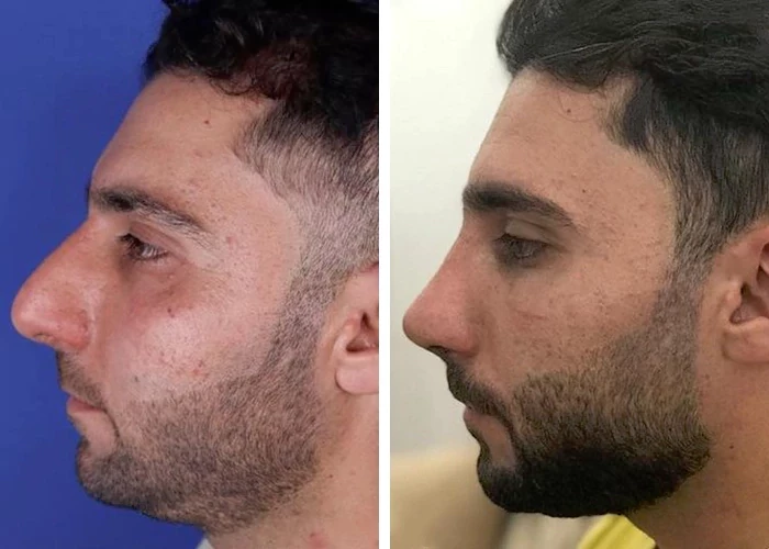 before & after photo of عمل زیبایی بینی