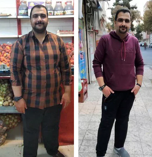 before & after photo of اسلیو معده