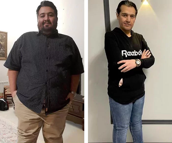 before & after photo of اسلیو معده